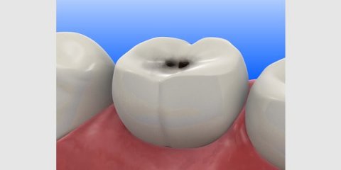 Кариес зубов-причины возникновения